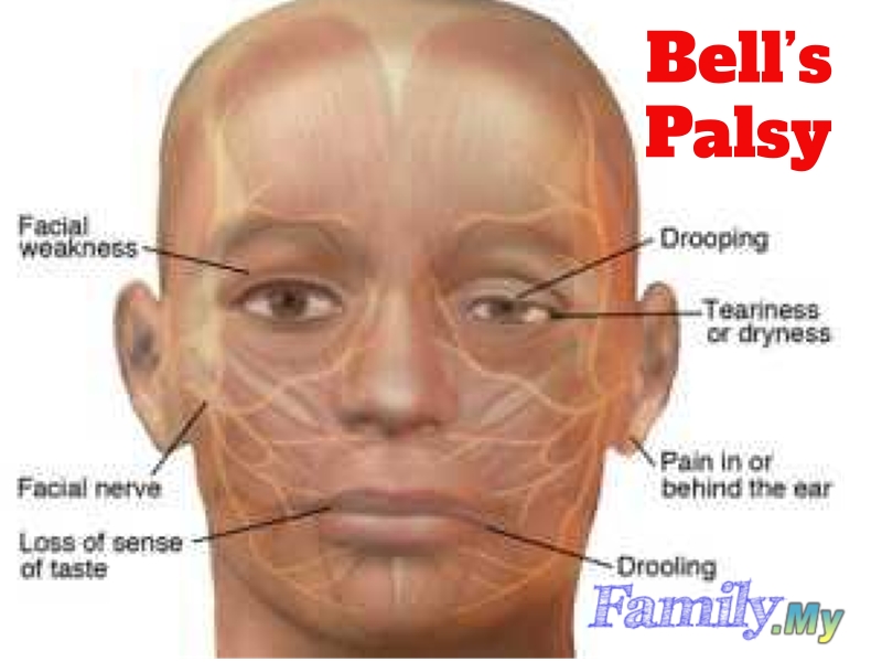 Bell's Palsy | Malaysia Health Family medicine and Healthcare