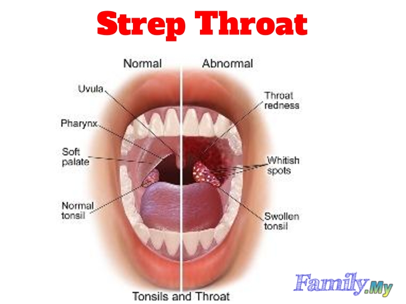 streptococcus throat